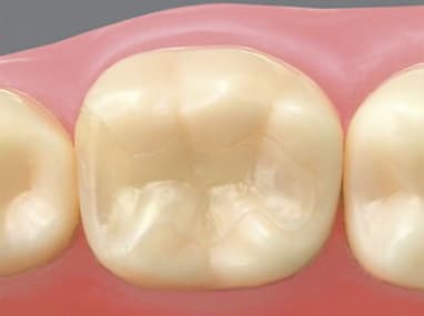 東日本橋・馬喰横山の歯医者、須藤デンタルクリニックのむし歯治療