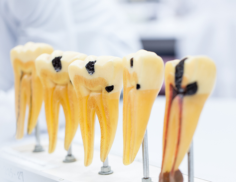 東日本橋・馬喰横山の歯医者、須藤デンタルクリニックのむし歯治療