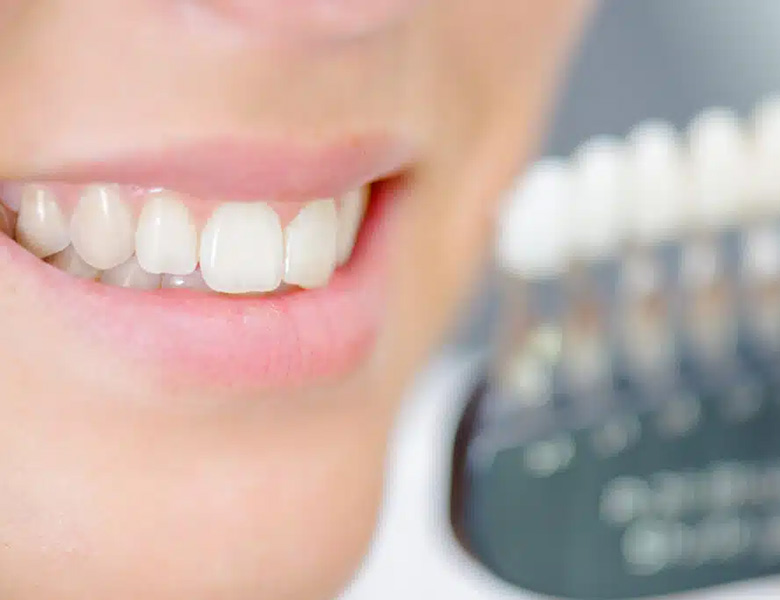 東日本橋・馬喰横山の歯医者、須藤デンタルクリニックのホワイトニング