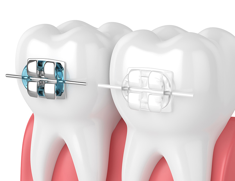 東日本橋・馬喰横山の歯医者、須藤デンタルクリニックの大人の矯正歯科