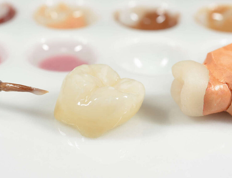 東日本橋・馬喰横山の歯医者、須藤デンタルクリニックの審美歯科治療