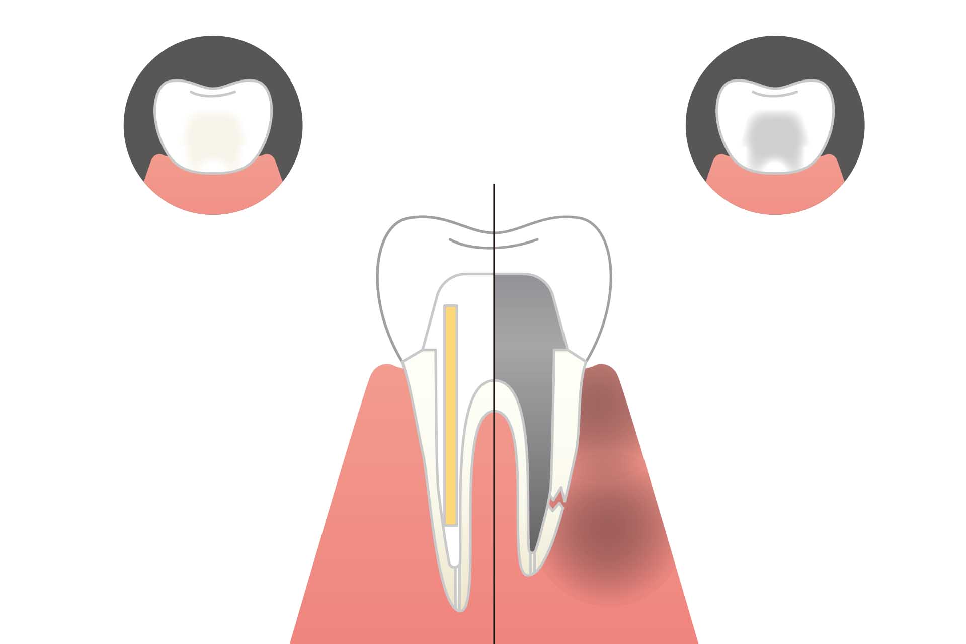 東日本橋・馬喰横山の歯医者、須藤デンタルクリニックの根管治療