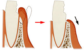 東日本橋・馬喰横山の歯医者、須藤デンタルクリニックのむし歯治療
