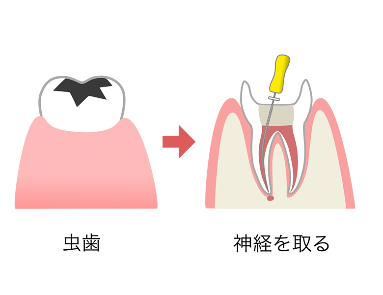 東日本橋・馬喰横山の歯医者、須藤デンタルクリニックで根管治療