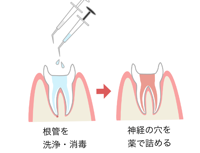 東日本橋・馬喰横山の歯医者、須藤デンタルクリニックで根管治療