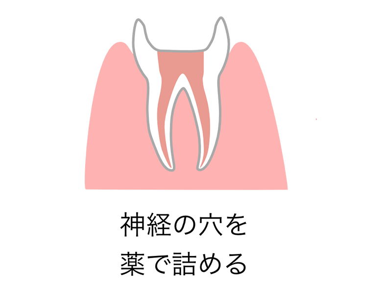 東日本橋・馬喰横山の歯医者、須藤デンタルクリニックで根管治療