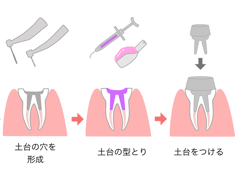 東日本橋・馬喰横山の歯医者、須藤デンタルクリニックで根管治療