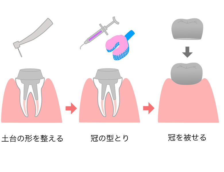 東日本橋・馬喰横山の歯医者、須藤デンタルクリニックで根管治療