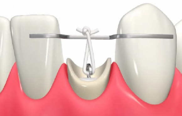 東日本橋・馬喰横山の歯医者、須藤デンタルクリニックのむし歯治療
