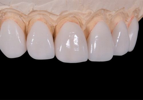 東日本橋・馬喰横山の歯医者、須藤デンタルクリニックの審美歯科治療