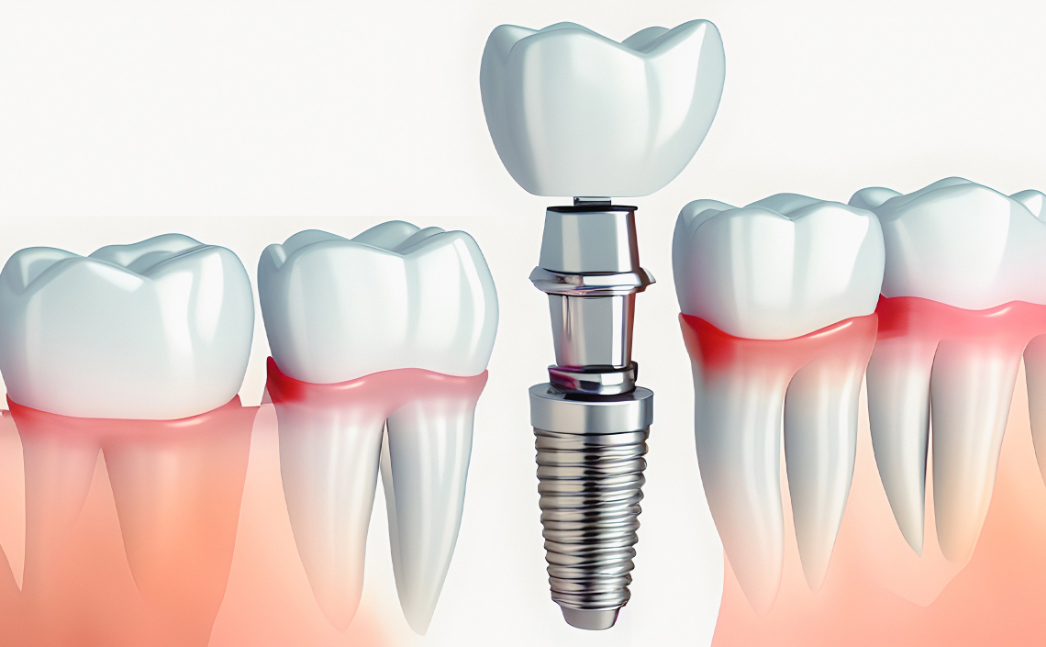 東日本橋・馬喰横山の歯医者、須藤デンタルクリニックのインプラント治療
