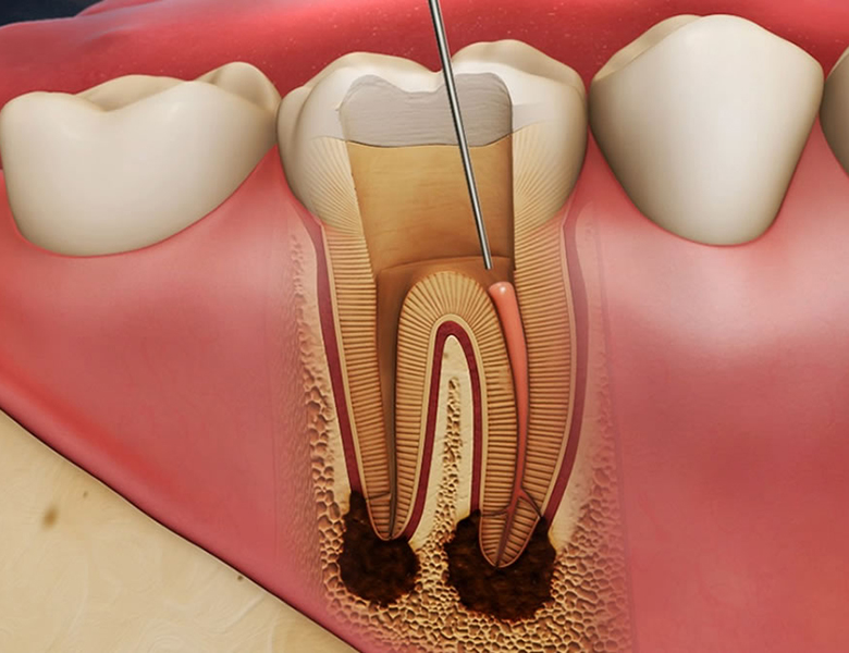 東日本橋・馬喰横山の歯医者、須藤デンタルクリニックの根管治療