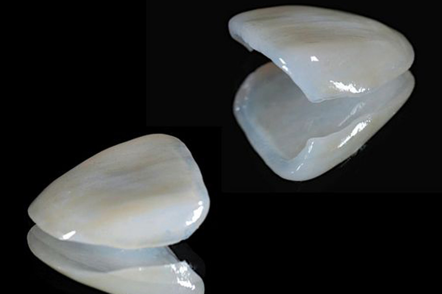 東日本橋・馬喰横山の歯医者、須藤デンタルクリニックの審美歯科治療