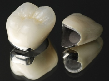 東日本橋・馬喰横山の歯医者、須藤デンタルクリニックの審美歯科治療