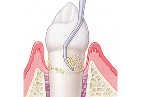 東日本橋・馬喰横山の歯医者、須藤デンタルクリニックの歯周病治療
