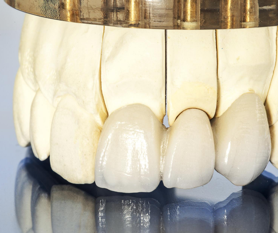 東日本橋・馬喰横山の歯医者、須藤デンタルクリニックの審美歯科治療